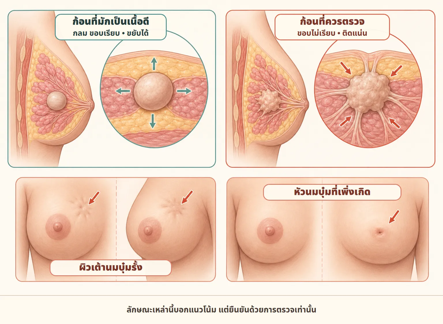 ภาพการแพทย์เปรียบเทียบก้อนเต้านม ด้านซ้ายเป็นก้อนกลมขอบเรียบและขยับได้ ด้านขวาเป็นก้อนขอบไม่เรียบที่รั้งติดกับเนื้อเยื่อ พร้อมภาพผิวเต้านมบุ๋ม และหัวนมบุ๋มที่เพิ่งเกิด
