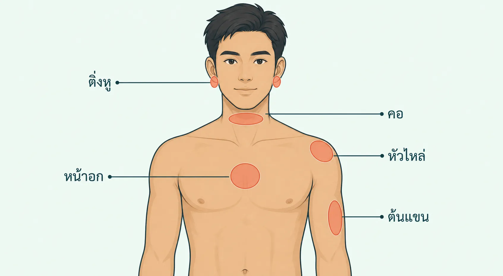 แผนภาพร่างกายส่วนบนแสดงตำแหน่งที่เกิดคีลอยด์ได้บ่อย ได้แก่ ติ่งหู คอ หน้าอก หัวไหล่ และต้นแขน