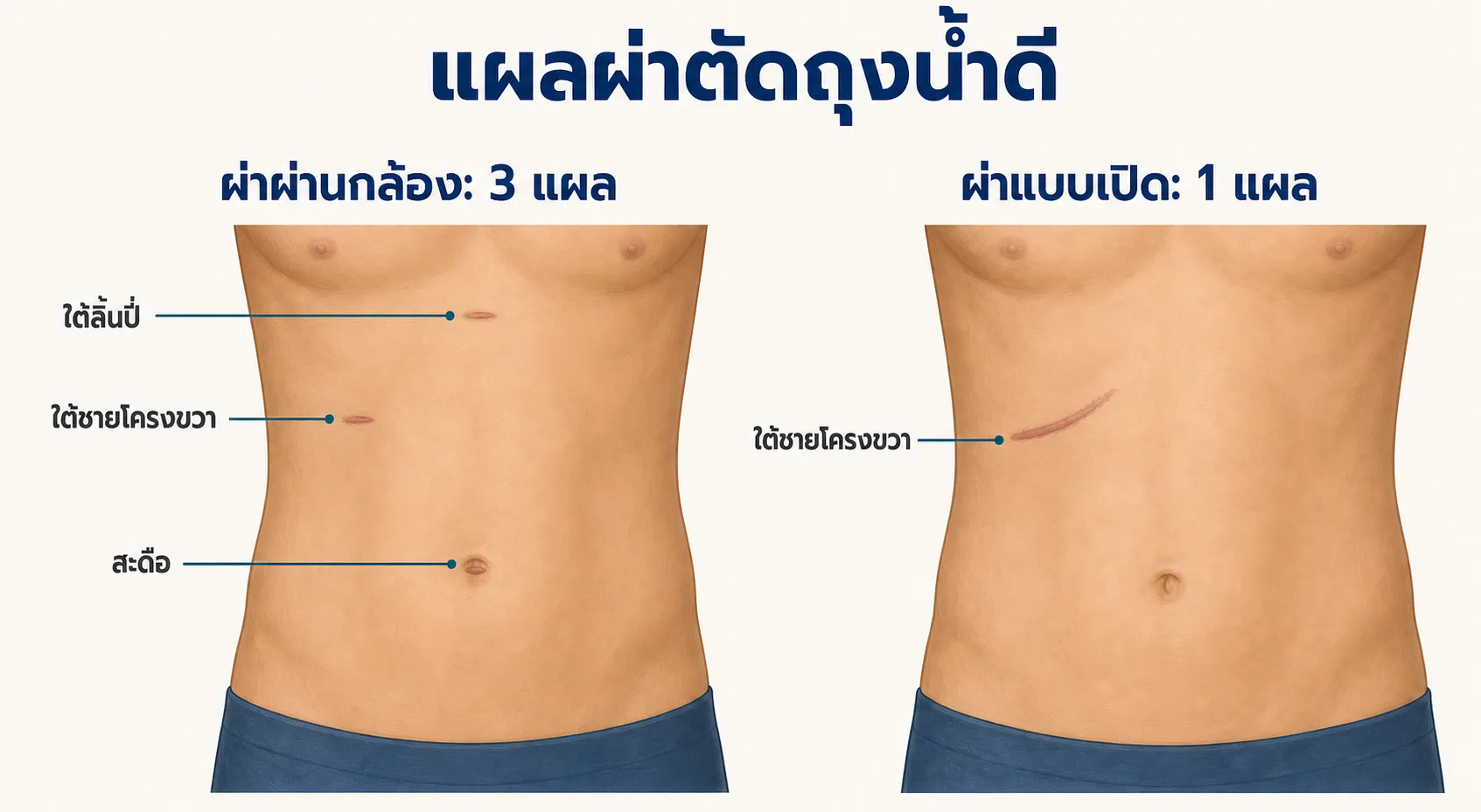 ภาพเปรียบเทียบแผลผ่าตัดถุงน้ำดีบนหน้าท้อง ฝั่งซ้ายเป็นการผ่าผ่านกล้อง มีแผลเล็กสามตำแหน่งที่สะดือ ใต้ลิ้นปี่ และใต้ชายโครงขวา ฝั่งขวาเป็นการผ่าแบบเปิด มีแผลยาวหนึ่งแผลใต้ชายโครงขวา
