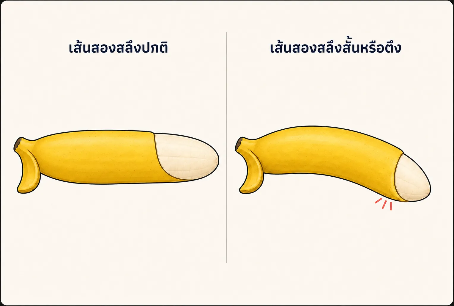 ภาพกล้วยสองช่องเปรียบเทียบเส้นสองสลึง ฝั่งซ้ายปลายตรงและขอบล่างเรียบ ฝั่งขวามีพับสั้นตึงรั้งให้ปลายงุ้มลง พร้อมรอยแดงเล็กตรงจุดที่อาจฉีก