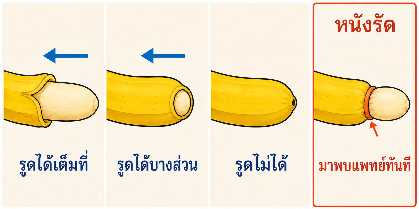 ภาพกล้วยสี่ช่องใช้เปลือกกล้วยแทนหนังหุ้มปลาย แสดงรูดได้เต็มที่ รูดได้บางส่วนโดยมองเห็นเนื้อกล้วยภายในรูเปิด รูดไม่ได้โดยเห็นเพียงรูเปิดแคบ และหนังรัดซึ่งเปลือกถูกดึงลงแล้วติดค้างอยู่ด้านหลัง