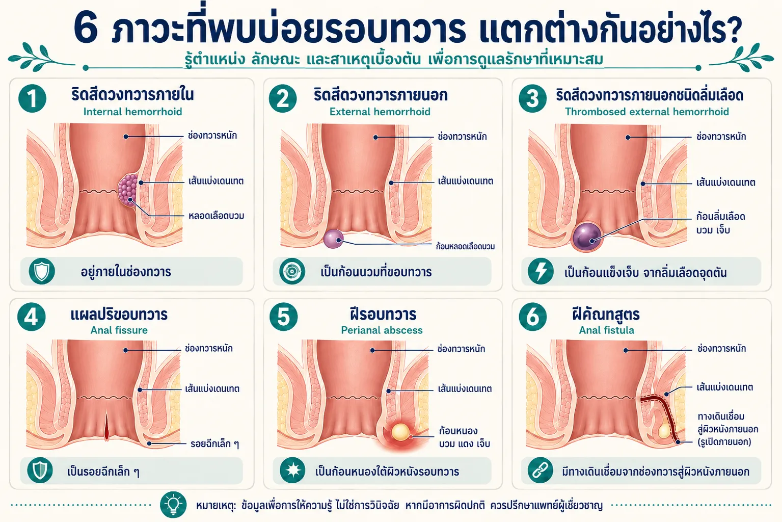 อินโฟกราฟิกให้ความรู้เปรียบเทียบ 6 ภาวะที่พบบ่อยบริเวณทวารหนัก ได้แก่ ริดสีดวงทวารภายใน ริดสีดวงทวารภายนอก ริดสีดวงทวารภายนอกชนิดลิ่มเลือด แผลปริขอบทวาร ฝีรอบทวาร และฝีคัณฑสูตร โดยแสดงตำแหน่งและลักษณะสำคัญผ่านภาพกายวิภาคแบบแผนผัง เพื่อช่วยให้เข้าใจความแตกต่างเบื้องต้น ข้อมูลนี้ใช้เพื่อการให้ความรู้ ไม่สามารถใช้แทนการวินิจฉัยหรือคำแนะนำจากแพทย์ได้