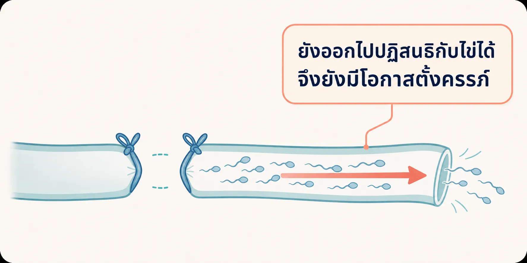 แผนภาพท่อนำอสุจิที่ตัดและผูกแล้ว มีตัวอสุจิค้างในท่อส่วนปลาย พร้อมลูกศรชี้ไปทางออกและข้อความว่ายังทำให้ตั้งครรภ์ได้